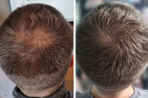 James, a Hair Saviour customer, shares his before and after results 