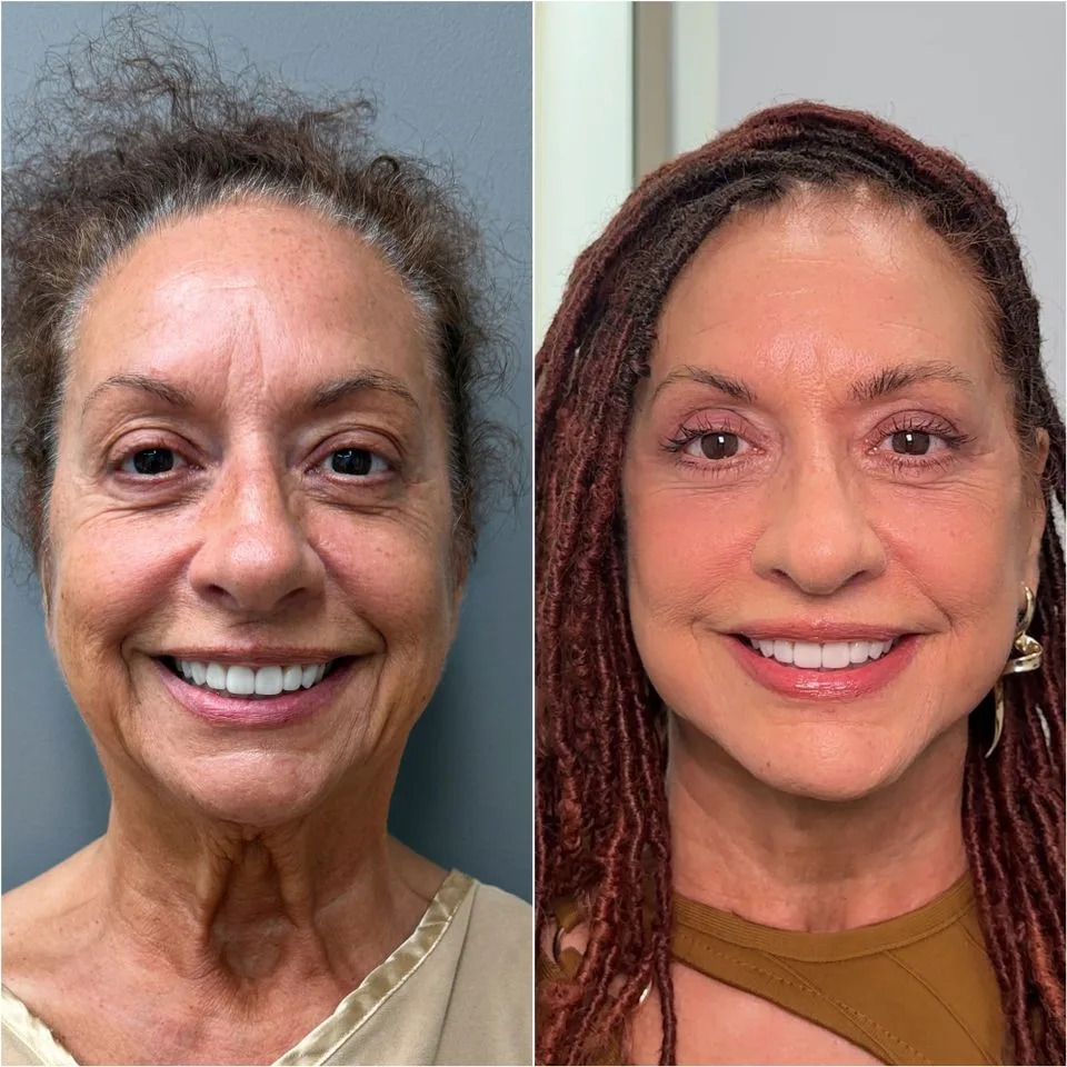Dr. Carl Truesdale Susanne before and after her surgery performed by Dr. Carl Truesdale