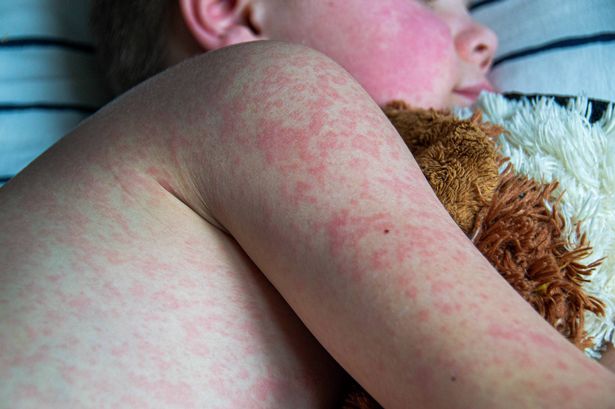 Child with measles