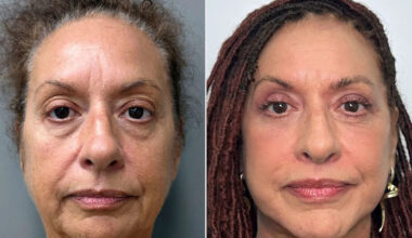Woman, 70, Says She Was 'Always' Confident. Then She Spent 8 Hours Getting Dramatic Plastic Surgery (Exclusive)
