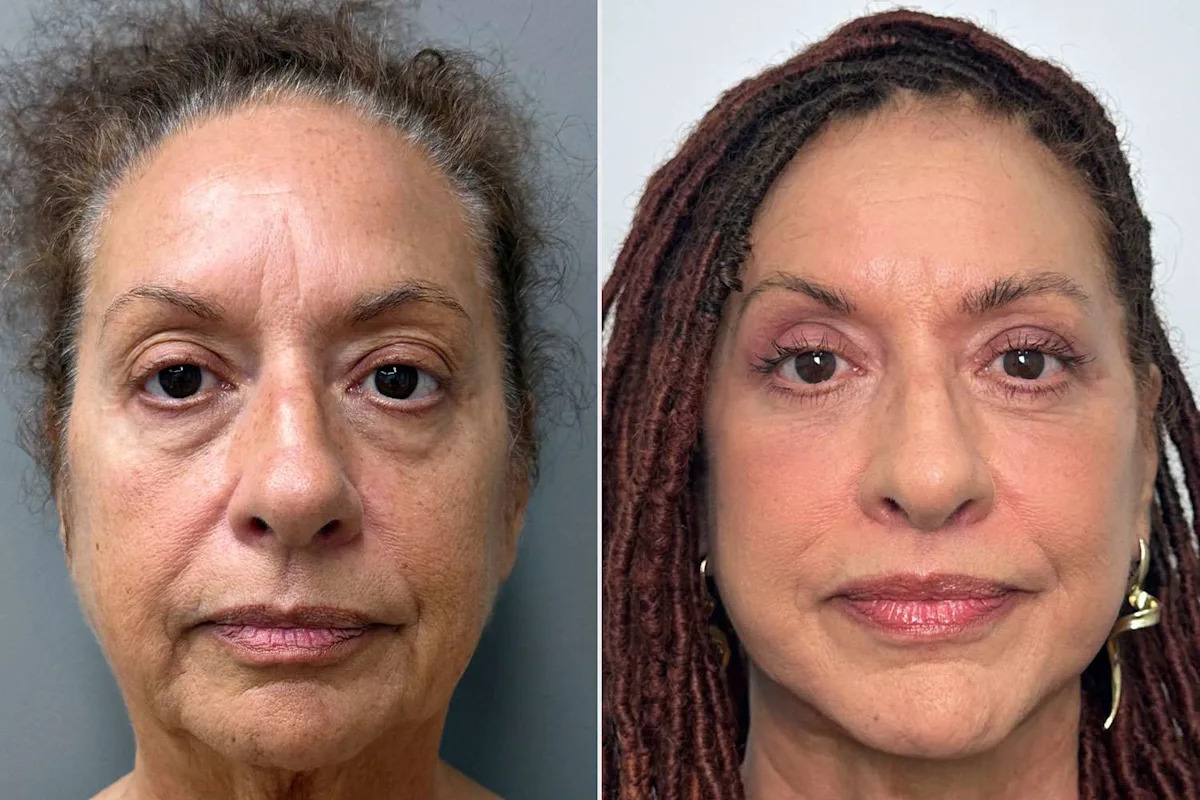 Woman, 70, Says She Was 'Always' Confident. Then She Spent 8 Hours Getting Dramatic Plastic Surgery (Exclusive)