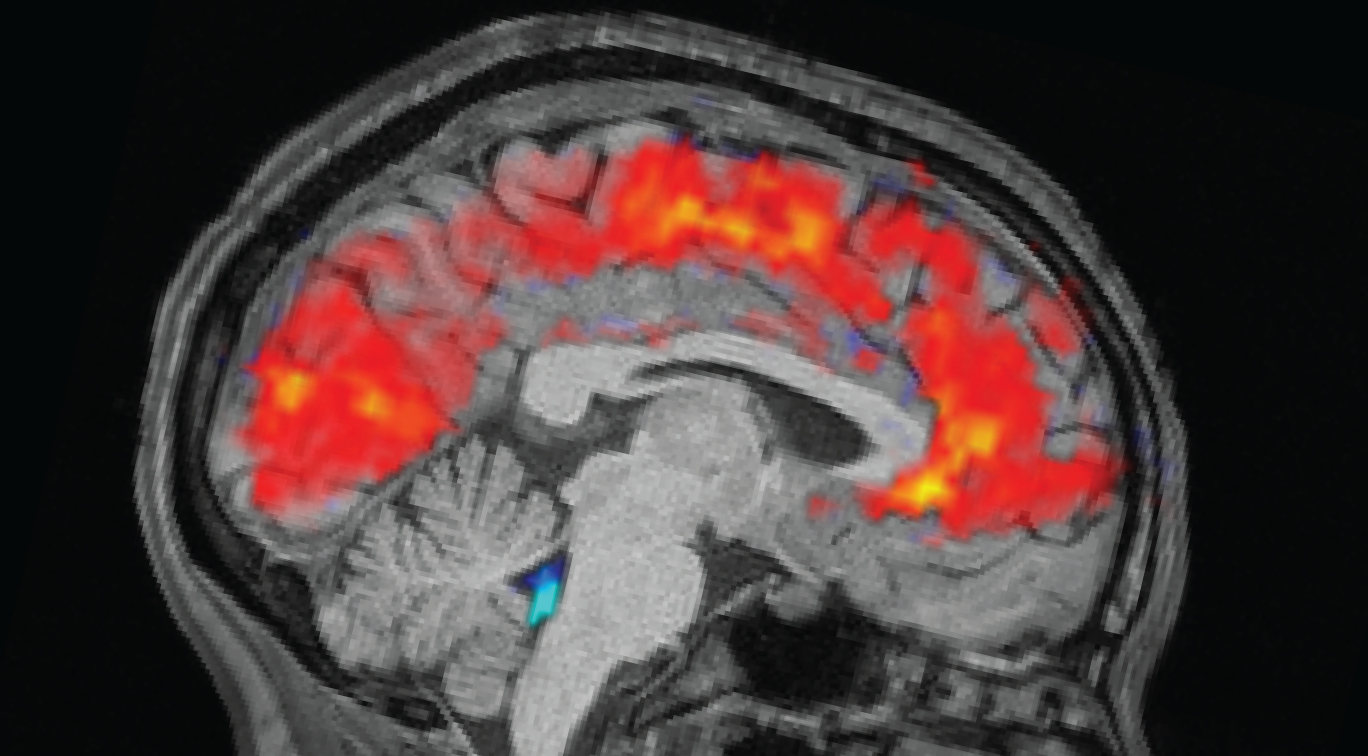 Grey scale brain scan showing changes in blood flow in red and cerebrospinal fluid in blue.