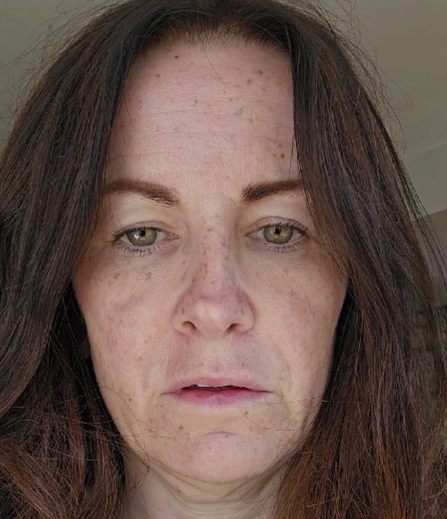 PIC FROM Kennedy News and Media (PIC SHOWS: VICTORIA ABOTORABI, 50, EXPERIENCED NERVE PAIN AND MUSCLE SPASMS AFTER SUFFERING AN ADVERSE REACTION TO A COMMON ANTIBIOTIC) A mum suffering from an agonising five-month headache feared she was DYING and wrote goodbye letters to her kids - but it was a reaction to a common antibiotic. Victoria Abotorabi, who lives in Leeds, was prescribed a course of antibiotics to treat a suspected ear infection in June 2024. The 50-year-old began taking a three-week course of ciprofloxacin, which belongs to a group of antibiotics known as fluoroquinolones that are often used to treat a variety of bacterial infections. DISCLAIMER: While Kennedy News and Media uses its best endeavours to establish the copyright and authenticity of all pictures supplied, it accepts no liability for any damage, loss or legal action caused by the use of images supplied and the publication of images is solely at your discretion. SEE KENNEDY NEWS COPY - 0161 697 4266