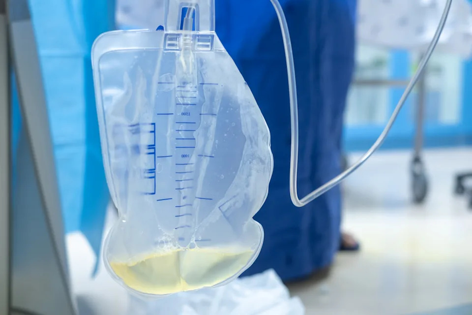 Urine bag medical treatment drainage bladder rubber flexible body infection bacteria output measure tract toilet leg relieve cancer device calculi vesical problem anatomy sterile surgical urethra.