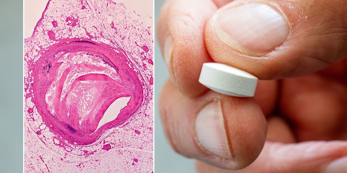 Drug that slashes bad cholesterol levels by nearly 60% offers hope to statin-resistant patients