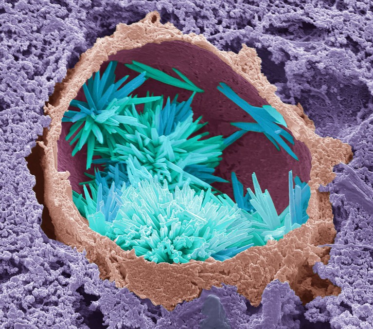 Coloured scanning electron micrograph of cholesterol crystals (blue) within a lipid droplet (brown) in a human liver.