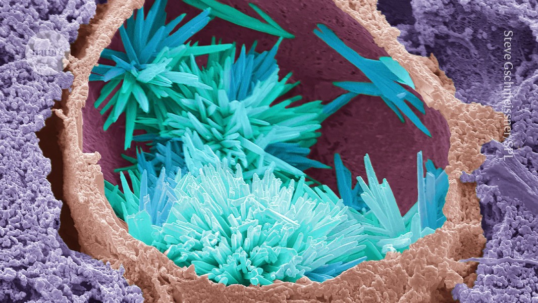 can gene editing prevent heart disease?