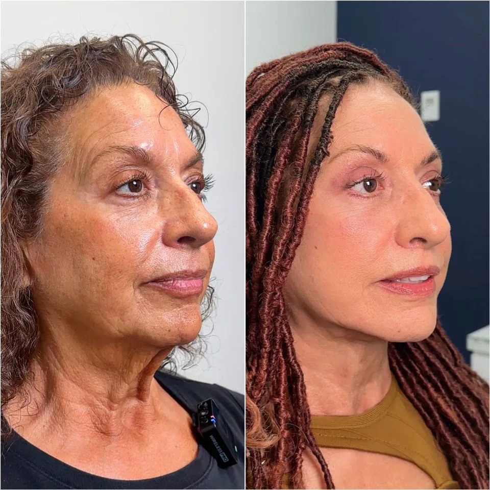 Dr. Carl Truesdale Susanne before and after her life-changing cosmetic enhancment