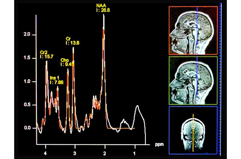 A non-invasive imaging technique, 1H-MRS, can detect chemicals in different parts of the brain. Choline is represented by "Cho" in the above graph. Credit: UC Regents Low choline levels in the brain associated with anxiety disorders