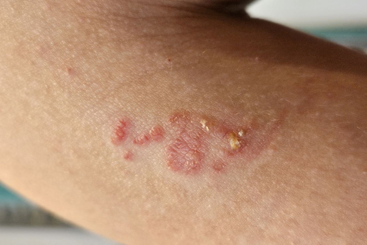 Scabies rash