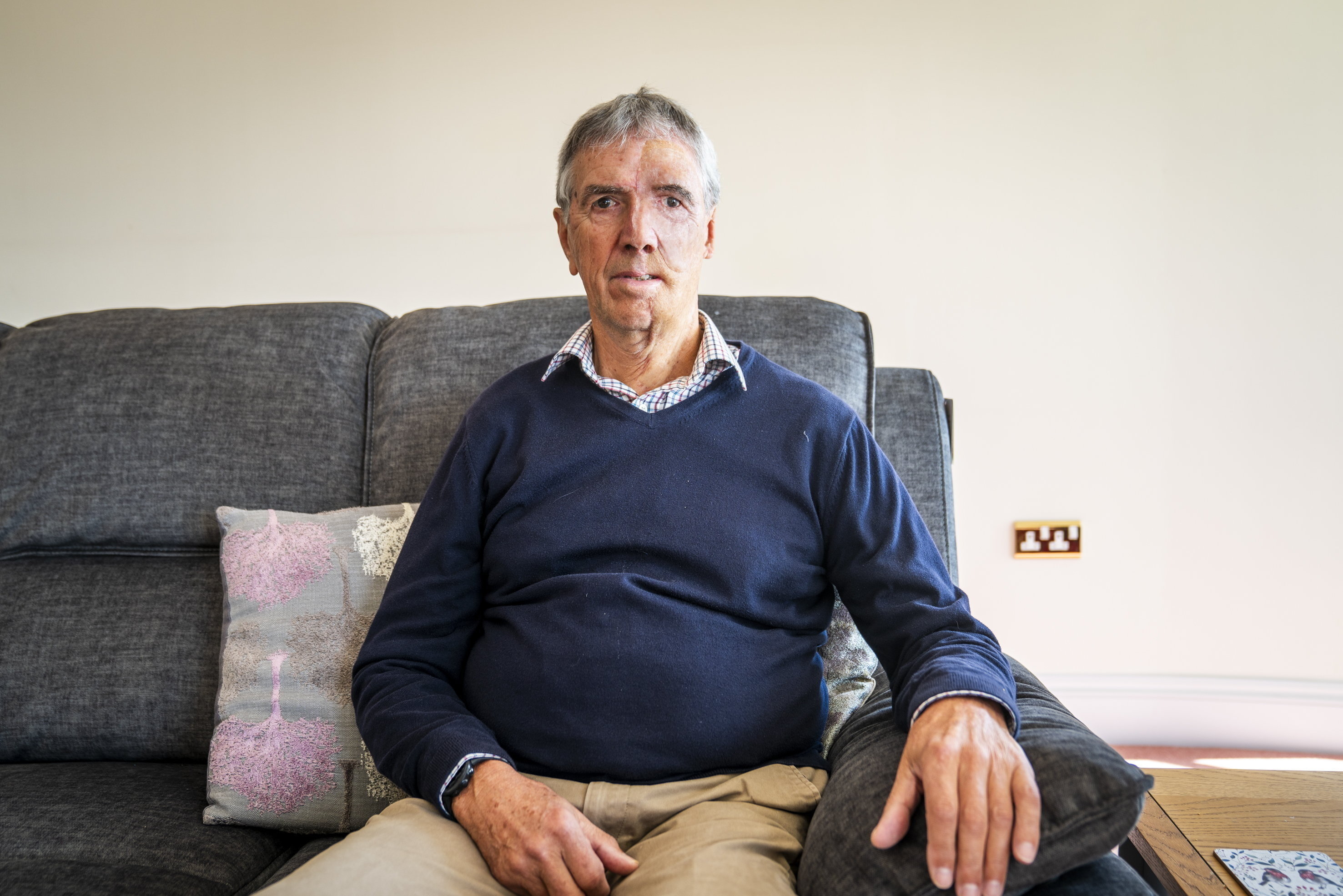 Dave Richards, a 75-year-old cyclist, sits on a couch at home, showcasing the 3D prosthesis that mimics his original features after a serious injury.