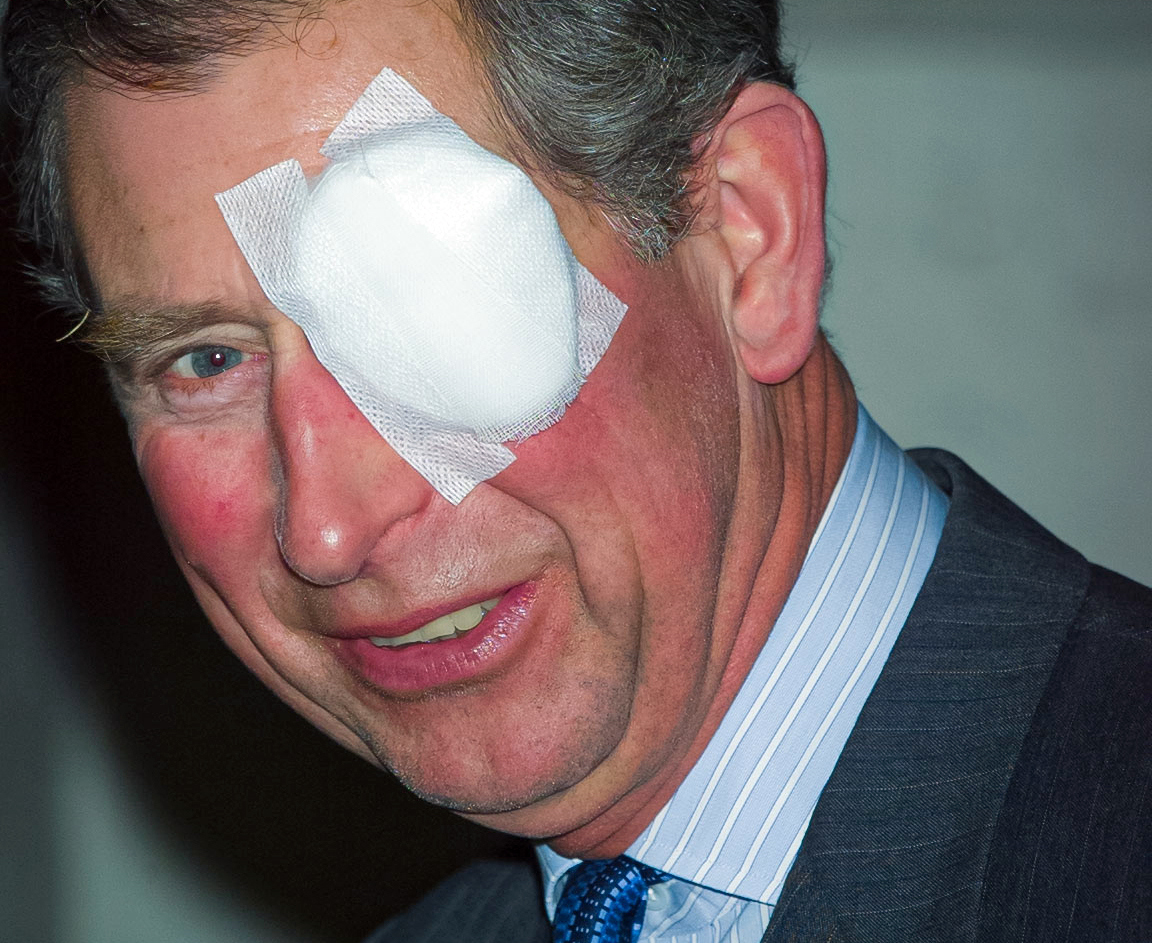 Prince Charles with a bandage over his left eye.