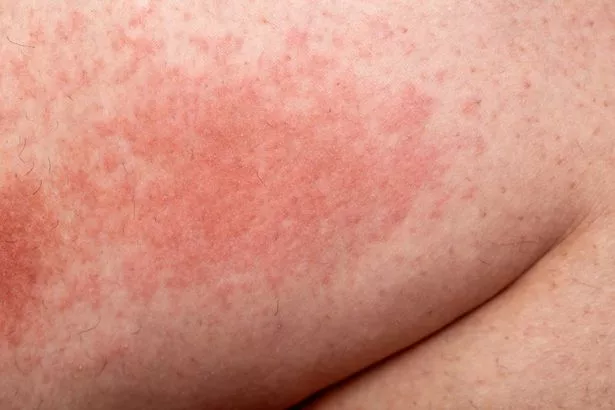 Scabies rash