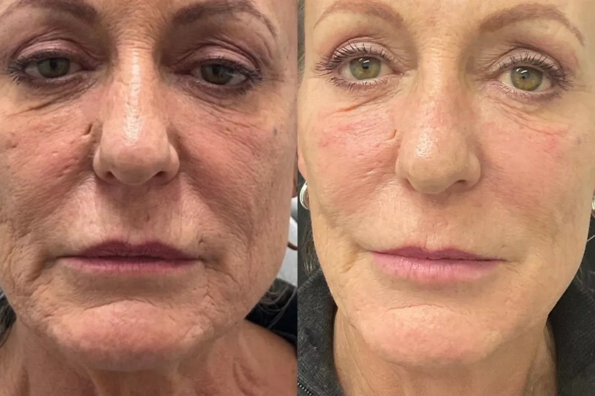 An expert is warning about the side effects of Ozempic