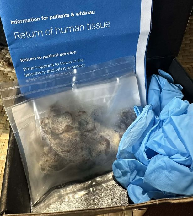 Part of LeeRay's lung appeared blackened when it was removed