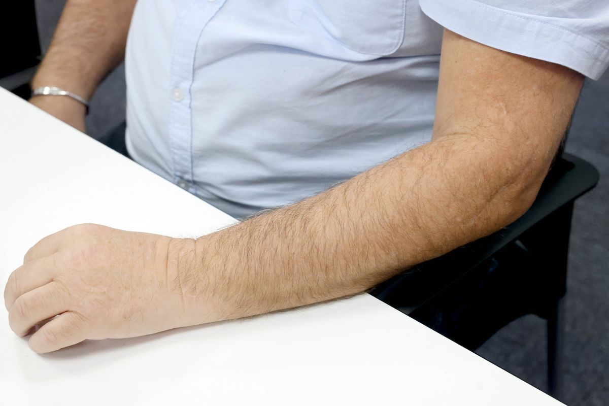 Scarring to Paul McCann's arm