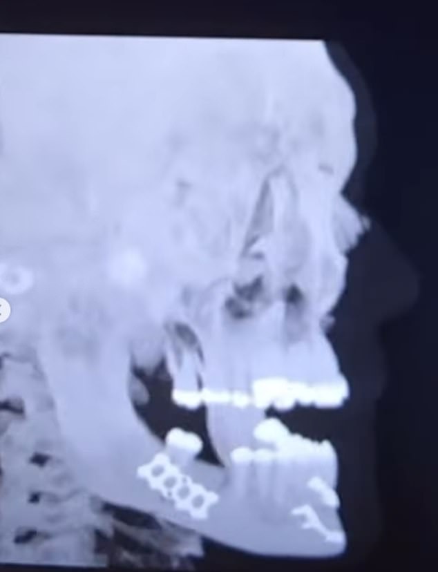 'The Problem Child' later posted a photo of his x-ray confirming a double fracture to his jaw