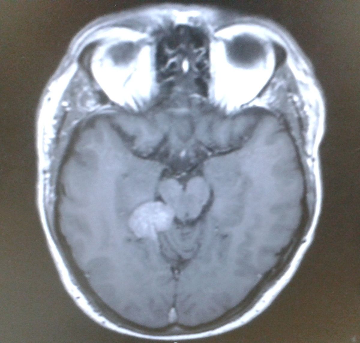 A scan of Darren's head showing his brain tumour