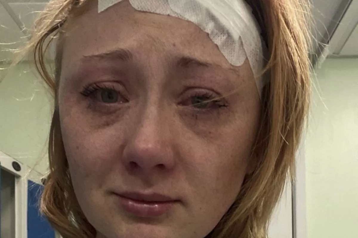 Stacey Galfiskiy after having her mole removed.