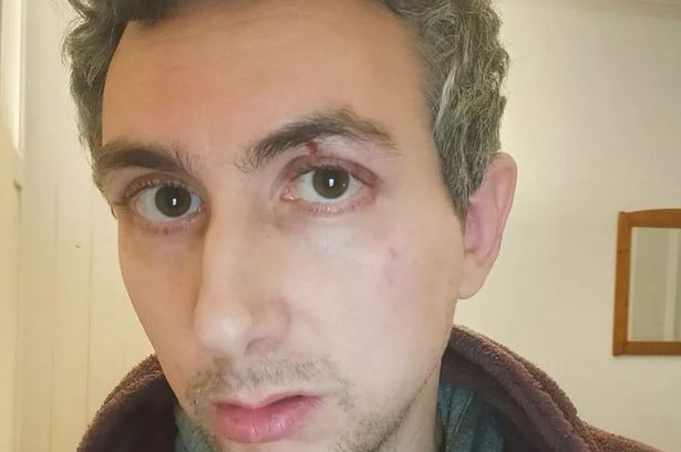 Giuseppe with scar on eye