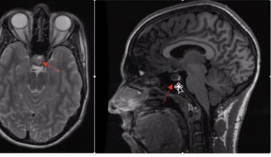 Medical Mysteries: For years she was told it was stress – a brain scan revealed the real cause