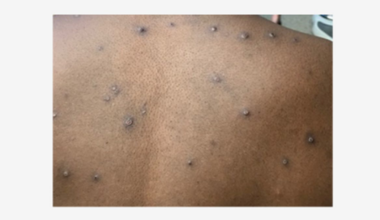 New hybrid mpox strain discovered in UK