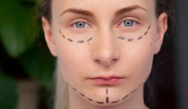 A woman with facial markings before plastic surgery in the United States