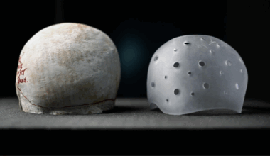 Inside North Bristol NHS Trust's use of 3D printing to treat flat head syndrome