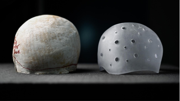 Inside North Bristol NHS Trust's use of 3D printing to treat flat head syndrome