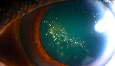 This Rare Condition Makes Your Eyes Sparkle Like a Christmas Tree : ScienceAlert