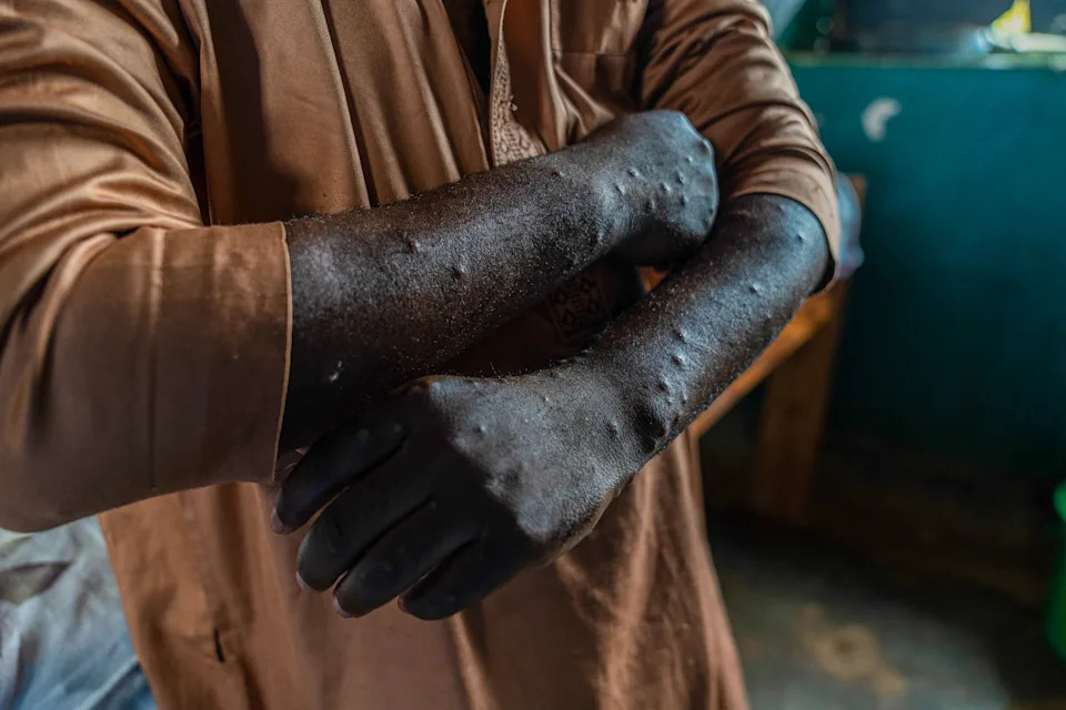 TOPSHOT - A patient infected with mpox shows lesions on his body at the treatment centre in Kamituga, South Kivu province in the east of the Democratic Republic of Congo on September 20, 2024. Kamituga, one of the localities hardest hit by the epidemic with around a thousand confirmed cases, will be one of the first to receive the doses, according to the provincial health authorities. Kamituga, one of the localities hardest hit by the epidemic with around a thousand confirmed cases, will be one of the first to receive the doses, according to the provincial health authorities. (Photo by Glody MURHABAZI / AFP) (Photo by GLODY MURHABAZI/AFP via Getty Images)