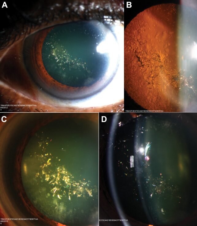 collage of four images showing a dilated pupil filled with green-gold sparkles at different levels of magnification.