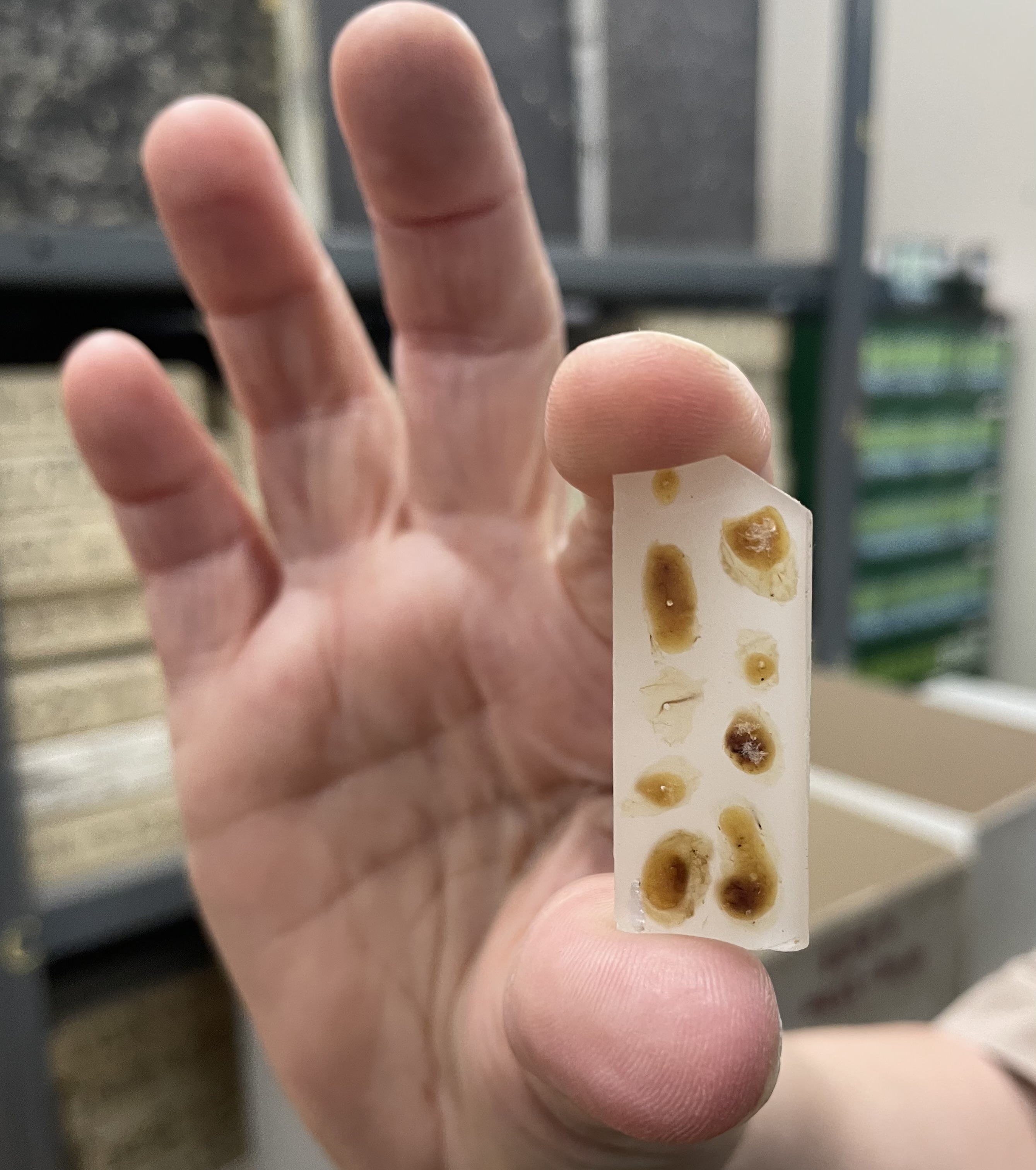 Biopsy samples embedded in a wax block held between two fingers.