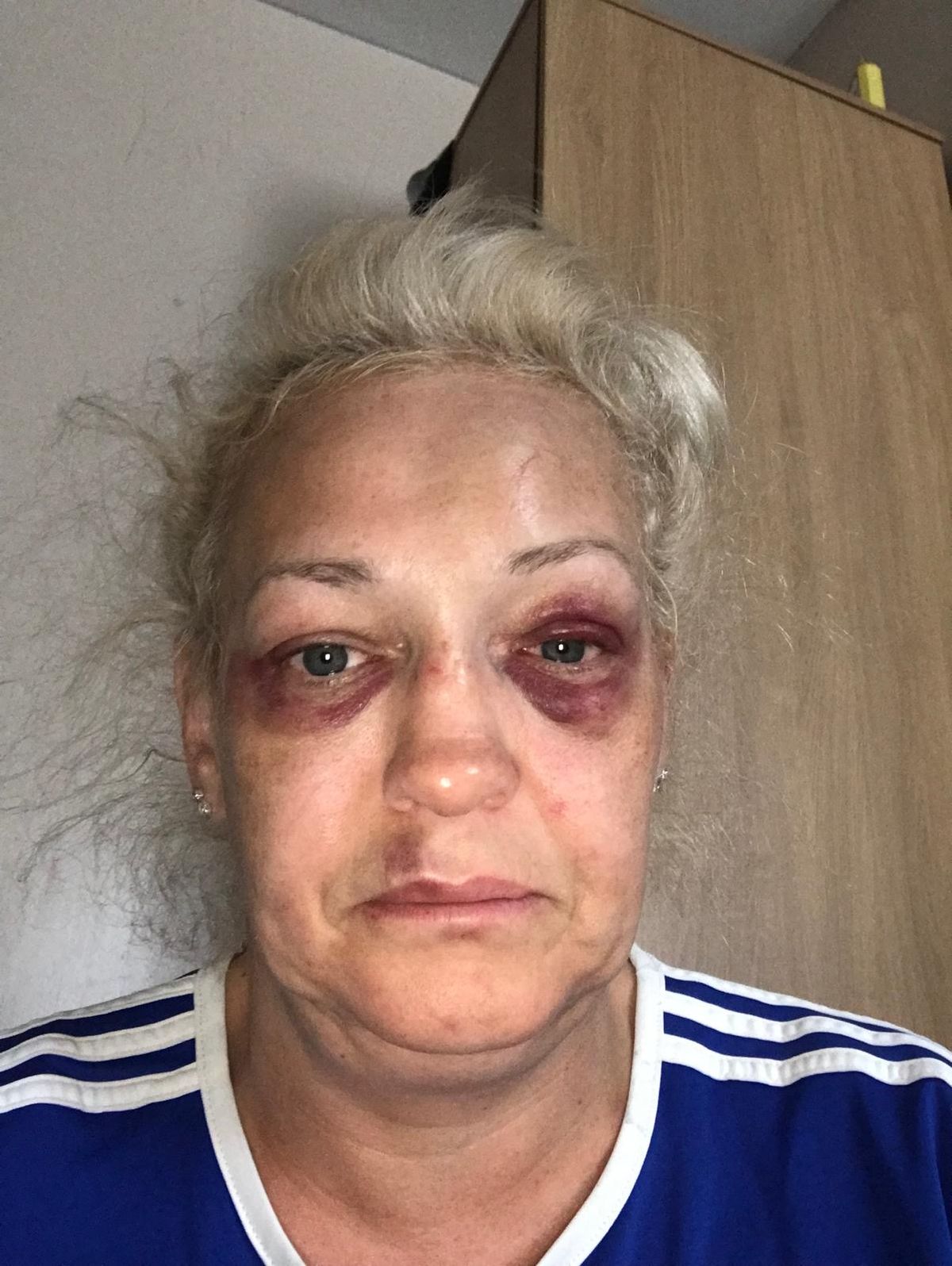 Injuries sustained by Tracy McHarg after she was assaulted by Kais Isawi 