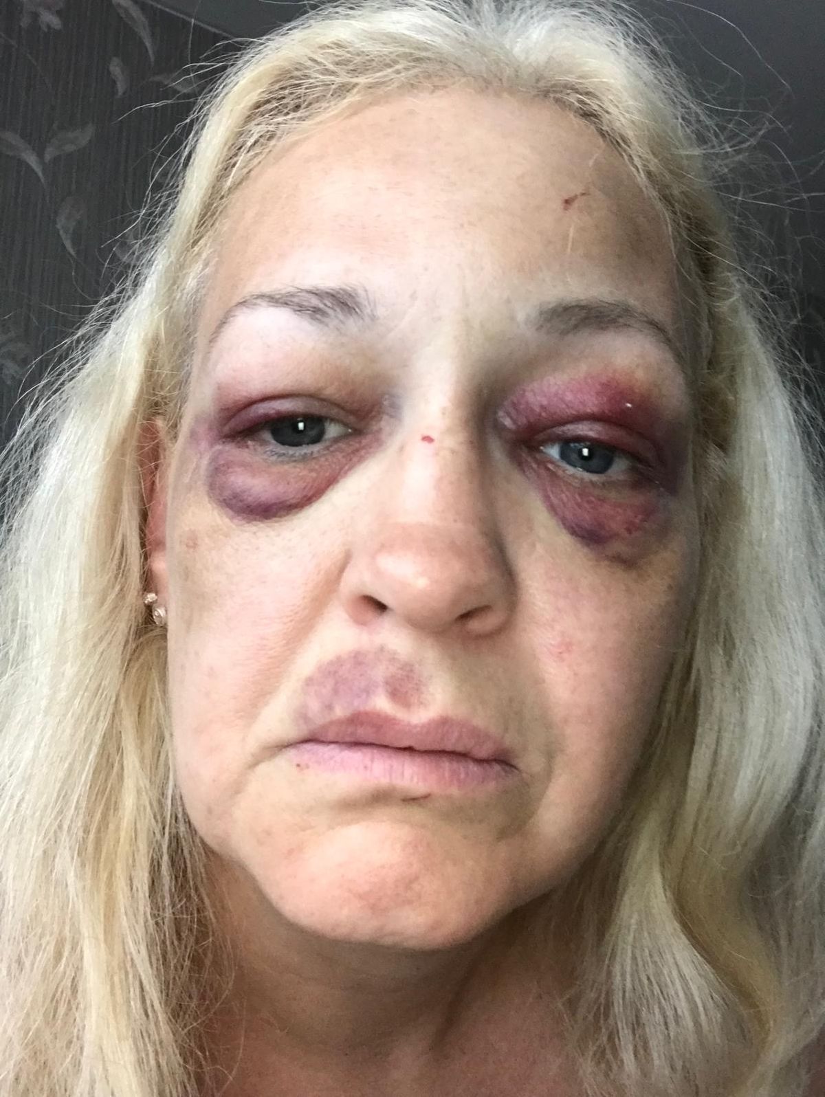 Injuries sustained by Tracy McHarg after she was assaulted by Kais Isawi 