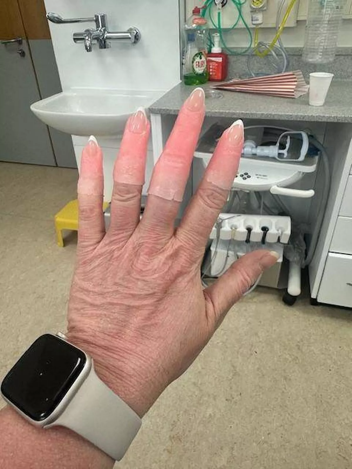 Louise with her new prosthetic fingers