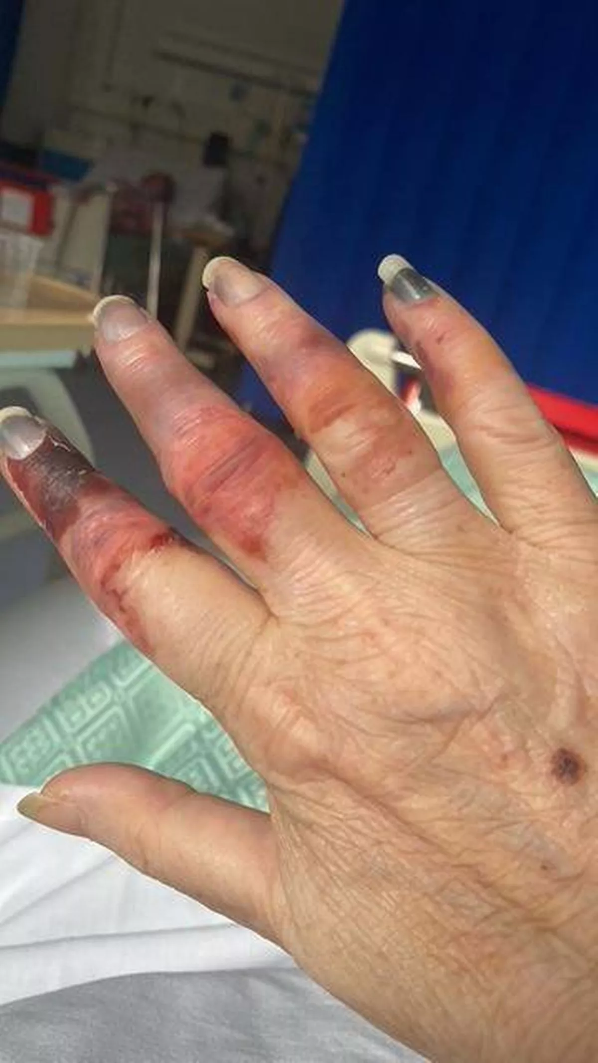 Louise in hospital showing her blackened fingers