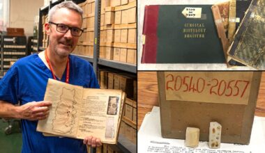 Tumour archive could solve mystery of bowel cancer surge in under-50s