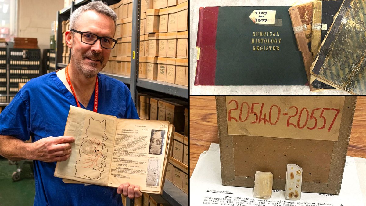 Tumour archive could solve mystery of bowel cancer surge in under-50s