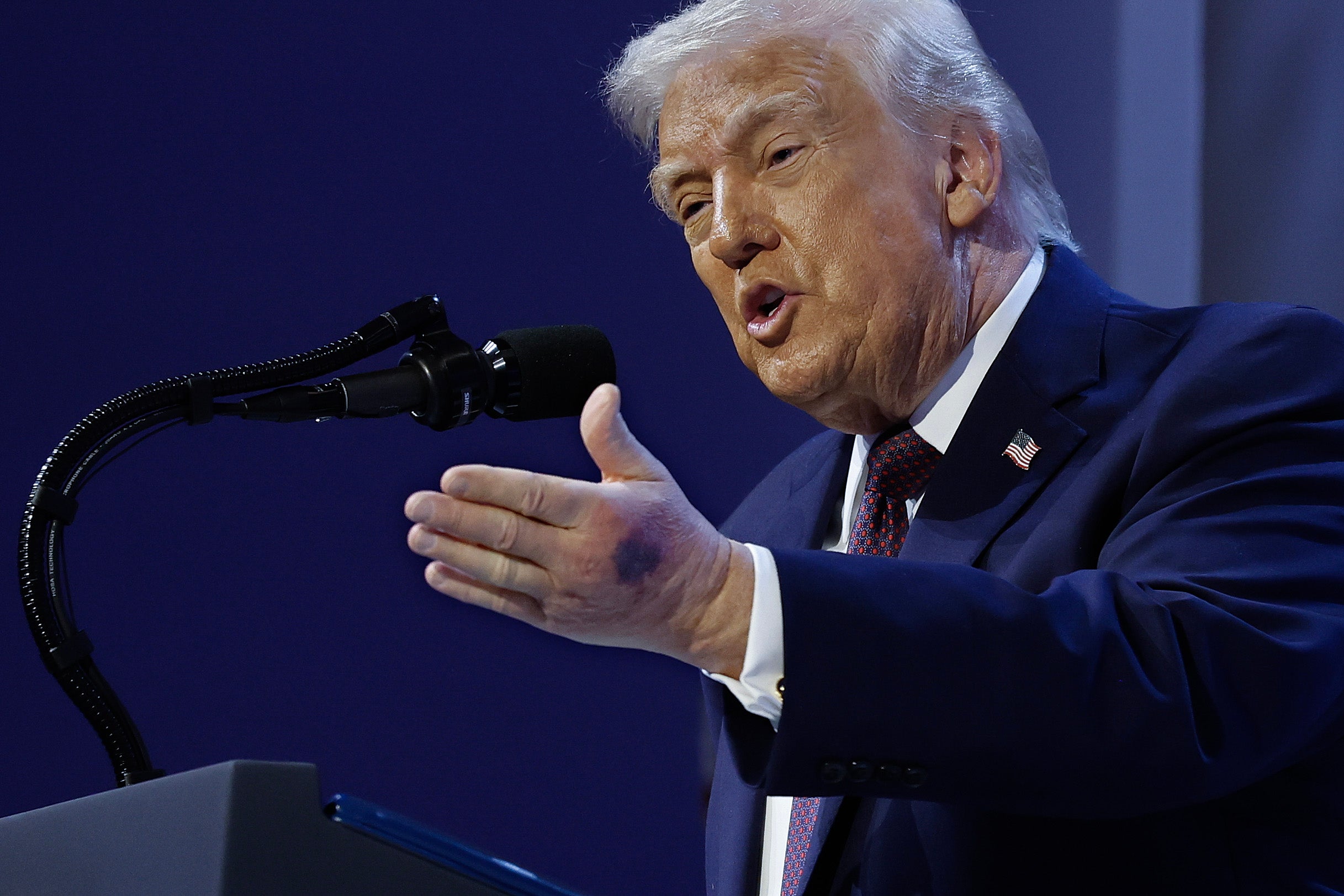 President Donald Trump has been pictured with a large bruise on his left hand while delivering a speech about his ‘board of peace’ in Davos, Switzerland