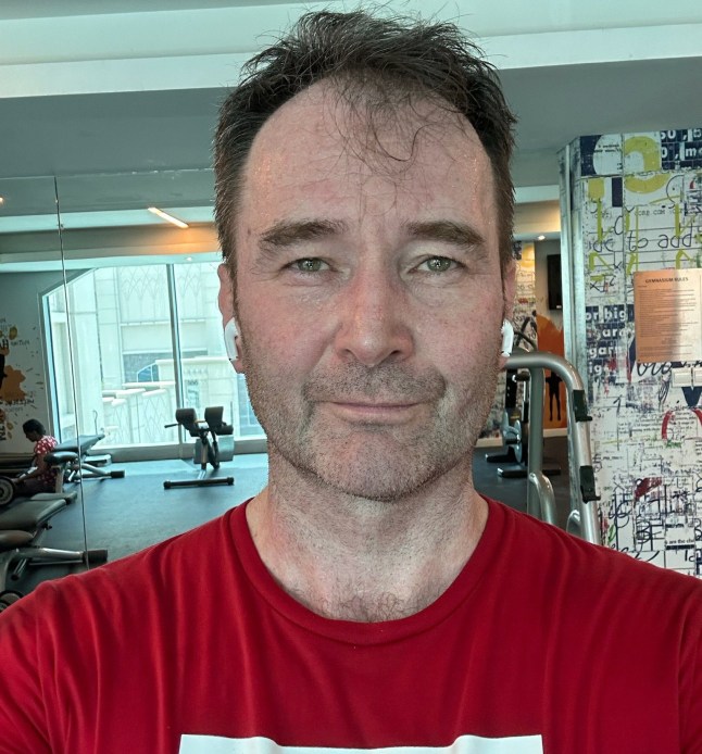 WARNING, GRAPHIC CONTENT - Story from Jam Press (Flesh Eating Bug) Pictured: Mark Brooks. Flesh-eating disease eats away fitness fanatic dad-of-three's arm?after sore throat A flesh-eating disease caused by a sore throat ate away a fitness fanatic?s arm. Mark Brooks needed 25 operations to cut away the muscle on his left arm after he was diagnosed with necrotising fasciitis. The 54-year-old blames going to the gym and pulling a muscle in his arm while recovering from a sore throat for the disease developing. ?I was fine and completely healthy and it came completely out of the blue,? Mark said. ?And then all of a sudden, I?m fighting for my life. It was ridiculous. ?I had the worst sore throat I?d ever had. ?Then I went to the gym and did an intense workout." Mark of Grimsby, Lincs, also told?NeedtoKnow: ?I was also fasting so I think that paved the way for the illness. ?While I was working out, I tweaked my elbow which was no big deal. ?Then I developed a fever so I slept like a champion. ?When I woke up, it felt like I?d smashed my elbow really hard on the bedside table. It was killing and I couldn?t use it. ?After that, I developed a fever and started puking like a champion. ?I thought it was bad luck that I had a bad elbow, a sore throat and food poisoning. ?I remember sitting on the carpet thinking that my decision making capacity was diminishing and that I only had one good decision left in me.? The dad-of-three went to hospital and medics assumed he had compartment syndrome, a painful condition from dangerous pressure buildup in a muscle compartment. But he was rushed into surgery when a large bruise appeared out of nowhere. Mark was diagnosed with necrotising fasciitis, or the flesh-eating disease that was eating away his skin and muscle. He had 25 operations to remove the dead skin, brachialis muscle, much of his tricep, a finger flexor and the connective tissue between muscles. The bacteria had also entered his bloodstream, triggering his kidneys to shut down. Mark said: ?I was in ICU for a week. ?They told me I had multi-organ failure. ?That sounded really bad. ?At one point, you could see straight through my arm. ?There was bone with nothing supporting it. ?It was grim to look at.? Mark spent nine weeks in hospital and still has more surgery to come. Doctors used a vacuum pack to keep the limb viable while fighting infection. Skin was later harvested from his leg and back in agonising graft procedures. He said: ?The donor sites were worse than the arm. ?I woke up in the worst pain of my life, crying uncontrollably. ?They removed a muscle from my back and swung it around to rebuild my arm. ?Then they removed fat from my stomach and packed it into my arm to support the exposed bone. ?If I?d gone to an orthopaedic surgeon, they would have amputated. ?One different decision, one different hospital, and my life would be totally different.? The cost of reconstruction has already reached around ?450,000, covered by insurance, with tens of thousands more expected. Mark says he developed PTSD since the ordeal in December 2023. He added: ?The antidote was gratitude. ?Thinking about what I still had, not what I?d lost.? ?Necrotising fasciitis has a mortality rate of around 20 per cent ? but in my case it was closer to 50% so I?m just thankful to be alive and have all my limbs. ?Hopefully, by telling this story, it saves someone else?s life.? ENDS