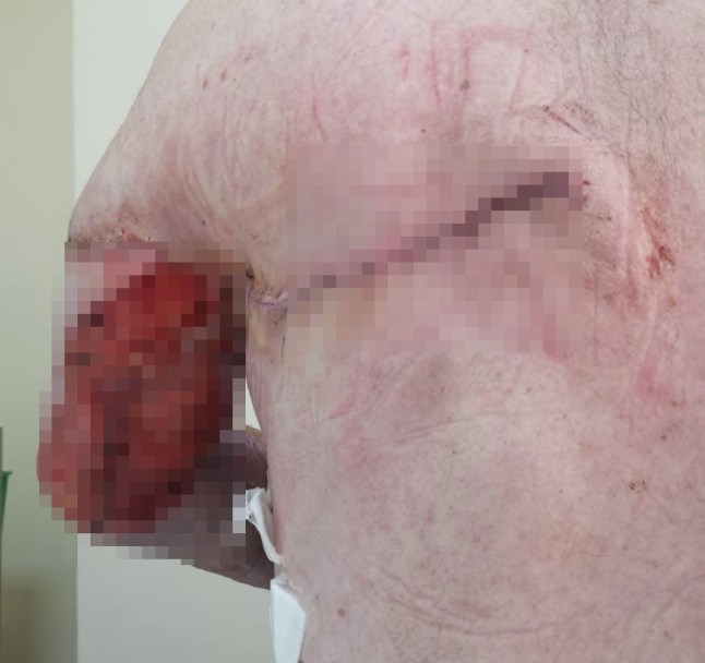 WARNING, GRAPHIC CONTENT - Story from Jam Press (Flesh Eating Bug) Pictured: Mark?s arm caused by flesh-eating disease. Flesh-eating disease eats away fitness fanatic dad-of-three's arm?after sore throat A flesh-eating disease caused by a sore throat ate away a fitness fanatic?s arm. Mark Brooks needed 25 operations to cut away the muscle on his left arm after he was diagnosed with necrotising fasciitis. The 54-year-old blames going to the gym and pulling a muscle in his arm while recovering from a sore throat for the disease developing. ?I was fine and completely healthy and it came completely out of the blue,? Mark said. ?And then all of a sudden, I?m fighting for my life. It was ridiculous. ?I had the worst sore throat I?d ever had. ?Then I went to the gym and did an intense workout." Mark of Grimsby, Lincs, also told?NeedtoKnow: ?I was also fasting so I think that paved the way for the illness. ?While I was working out, I tweaked my elbow which was no big deal. ?Then I developed a fever so I slept like a champion. ?When I woke up, it felt like I?d smashed my elbow really hard on the bedside table. It was killing and I couldn?t use it. ?After that, I developed a fever and started puking like a champion. ?I thought it was bad luck that I had a bad elbow, a sore throat and food poisoning. ?I remember sitting on the carpet thinking that my decision making capacity was diminishing and that I only had one good decision left in me.? The dad-of-three went to hospital and medics assumed he had compartment syndrome, a painful condition from dangerous pressure buildup in a muscle compartment. But he was rushed into surgery when a large bruise appeared out of nowhere. Mark was diagnosed with necrotising fasciitis, or the flesh-eating disease that was eating away his skin and muscle. He had 25 operations to remove the dead skin, brachialis muscle, much of his tricep, a finger flexor and the connective tissue between muscles. The bacteria had also entered his bloodstream, triggering his kidneys to shut down. Mark said: ?I was in ICU for a week. ?They told me I had multi-organ failure. ?That sounded really bad. ?At one point, you could see straight through my arm. ?There was bone with nothing supporting it. ?It was grim to look at.? Mark spent nine weeks in hospital and still has more surgery to come. Doctors used a vacuum pack to keep the limb viable while fighting infection. Skin was later harvested from his leg and back in agonising graft procedures. He said: ?The donor sites were worse than the arm. ?I woke up in the worst pain of my life, crying uncontrollably. ?They removed a muscle from my back and swung it around to rebuild my arm. ?Then they removed fat from my stomach and packed it into my arm to support the exposed bone. ?If I?d gone to an orthopaedic surgeon, they would have amputated. ?One different decision, one different hospital, and my life would be totally different.? The cost of reconstruction has already reached around ?450,000, covered by insurance, with tens of thousands more expected. Mark says he developed PTSD since the ordeal in December 2023. He added: ?The antidote was gratitude. ?Thinking about what I still had, not what I?d lost.? ?Necrotising fasciitis has a mortality rate of around 20 per cent ? but in my case it was closer to 50% so I?m just thankful to be alive and have all my limbs. ?Hopefully, by telling this story, it saves someone else?s life.? ENDS