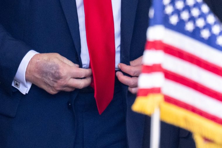 (FILES) A view of the hand of US President Donald Trump as he greets South Korean President Lee Jae Myung as he arrives at the West Wing entrance of the White House in Washington, DC, on August 25, 2025. Trump blamed aspirin for large bruises on his hand and denied falling asleep while attending public meetings in an interview with The Wall Street Journal published on January 1, 2026. In the interview defending his health, Trump also changed his previous statement about receiving an MRI scan in October, saying it was instead a quicker CT scan. (Photo by SAUL LOEB / AFP via Getty Images)