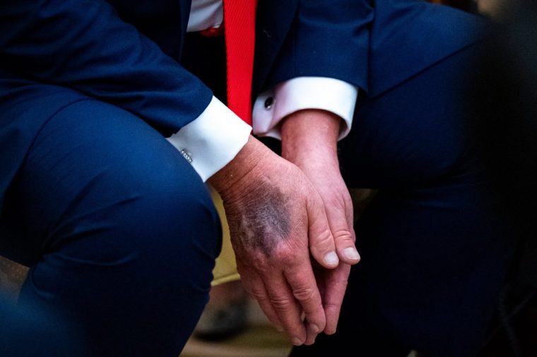 Donald Trump's hands with bruises