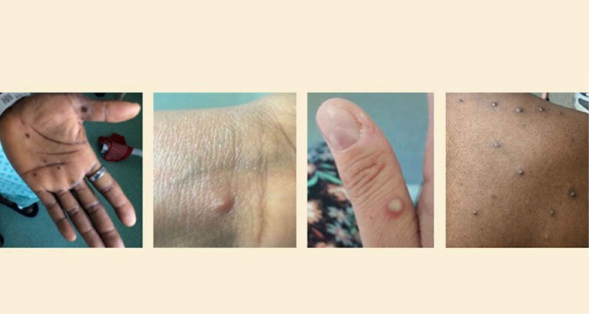 Traveler brings home a newly-evolved 'hybrid' mpox virus