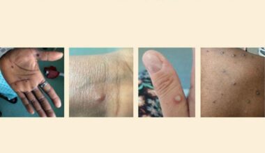 Traveler brings home a newly-evolved 'hybrid' mpox virus