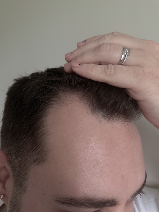 Male hair after using Tender Love and Hair - Men's Hair Vitamins