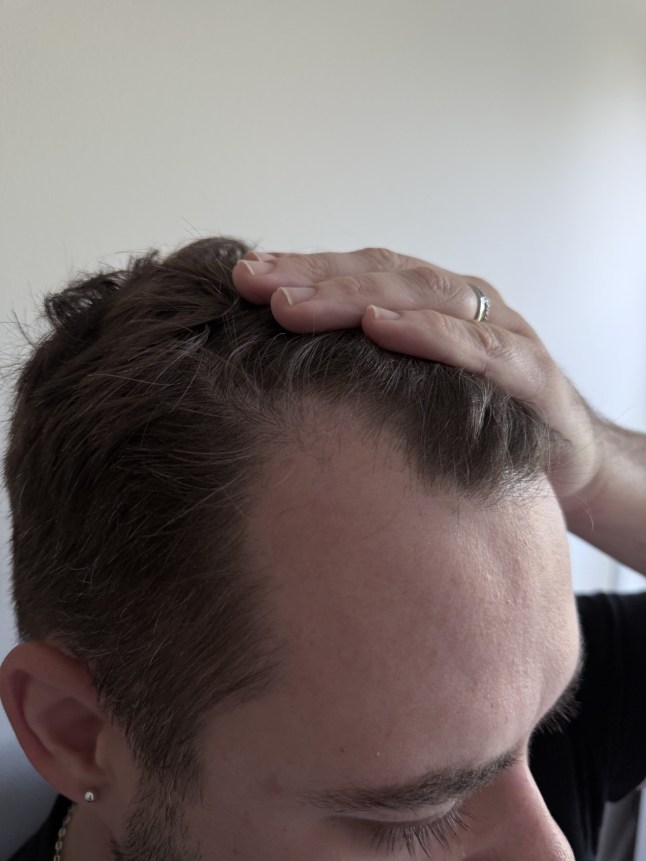 Male hair before using Tender Love and Hair - Men's Hair Vitamins