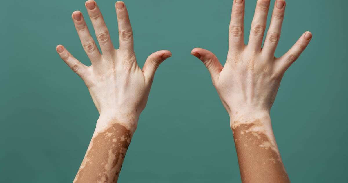 UAE approves new use of drug to treat vitiligo