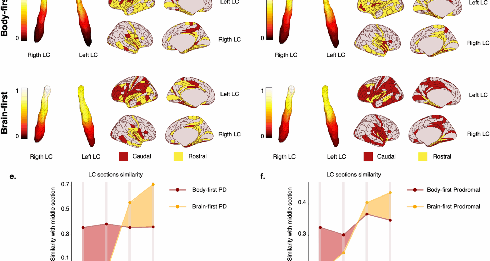 Clinical progression and genetic pathways in body-first and brain-first Parkinson’s disease | Molecular Neurodegeneration